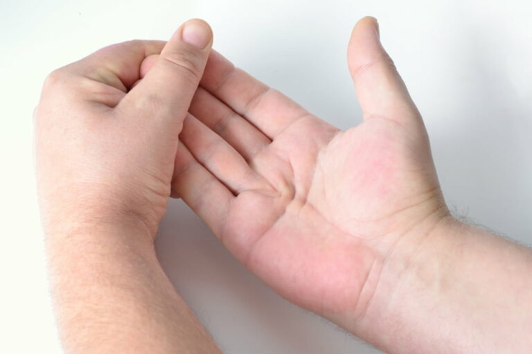 4 warning signs of Dupuytren’s contracture